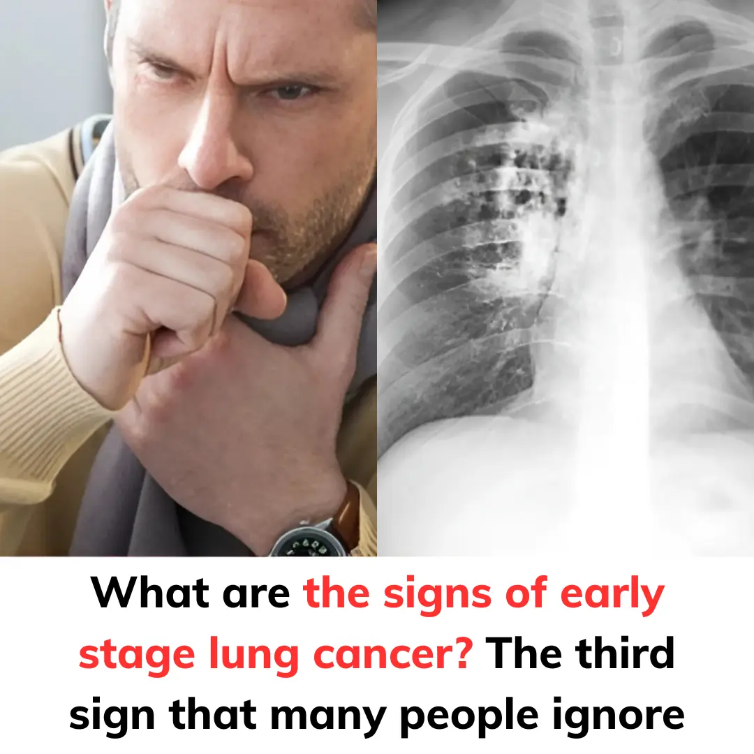 What are the signs of early stage lung cancer? The third sign that many people ignore