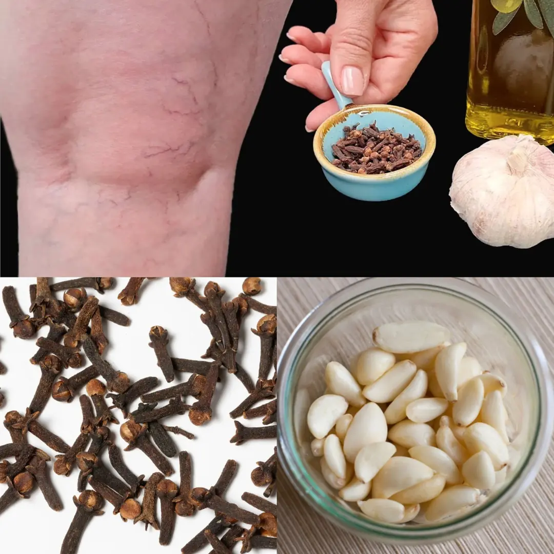 Leg Pain, Rheumatism, Varicose Veins, Arthritis – Natural Remedy with Cloves & Garlic!